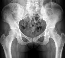 HIP X-RAY